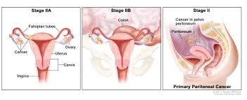 Essentially, they provide a connection between ovaries and the uterus. Ovarian Fallopian Tube Cancers Hematology Oncology Associates Of Cny
