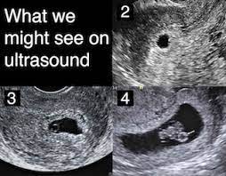 6 weeks pregnant belly pictures. Patience Is Key Understanding The Timing Of Early Ultrasounds Your Pregnancy Matters Ut Southwestern Medical Center