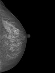 What does breast cancer look like? Breast Imaging With Ultrasound And Mammography