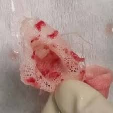 Sock Opened Up To Show Fragments Of Polyp Trapped Within Download Scientific Diagram