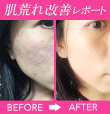 ヒドイ肌荒れがみるみる良くなったワケは 食生活改善レポート 肌荒れ スキンケア 美容