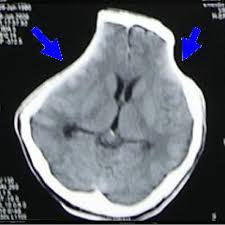 sinking skin flap syndrome