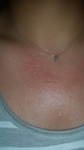 Do not wipe the vinegar dry rather leave it to air dry. Family Magazine How Long Does Sunburn Itch Last