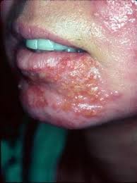 Image result for Impetigo