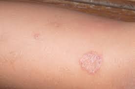 Kulit ialah merupakan sebuah organ paling luar dari anatomi tubuh manusia. Bisakah Kurap Disembuhkan Dengan Bahan Alami