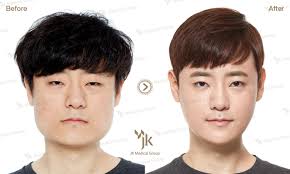 Jk Plastic Surgery In South Korea Korean Plastic Surgery Best Plastic Surgery In Korea Extreme Pla Korean Plastic Surgery Plastic Surgery Plastic Surgery Korea