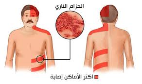 هل تعرف مرض الزونا Dermatologue Oujda Dr Sabah Bazouti Facebook