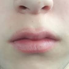 Lippen Trocken Und Wund Was Tun Wunde Lippe Kruste