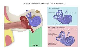 Image result for Inner Ear Decompression Sickness