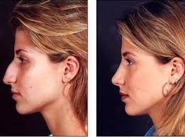 Nose Job Rhinoplasty Before And After Rhinoplasty