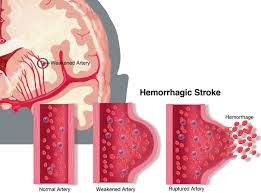 Image result for Stroke Pathophysiology