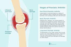How fast can ra progress? Stages Of Psoriatic Arthritis Signs Of Early To Late Disease Progression