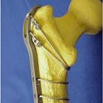 Greater trochanter fixed with a claw plate and cable system ...