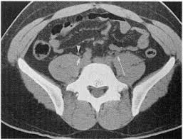 Image result for Helical CT Urogram