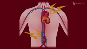 Aortic Aneurysm What You Need To Know Youtube Men and women suffer equally often.