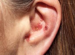 The treatment for marburg virus disease involves supportive care. Viral Skin Diseases Primary Care Clinics In Office Practice