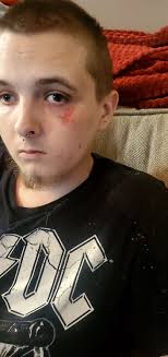 Devin update 7/12/23 Devin had a fall today. I was in the shower and he  needed to pee so he proceeded to go outside and fell into the garage door  going out.