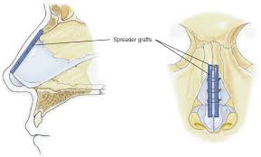 An extended osteocartilaginous spreader graft, with medial osteotomy and lateralization of the nasal bone on the concave side, is a new technique with a high success rate for correction of deviated nose. Definitive Rhinoplasty For Adult Cleft Lip Nasal Deformity Pocket Dentistry
