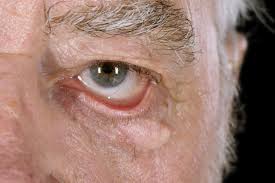 Check spelling or type a new query. Entropion And Ectropion Eye Disorders Merck Manuals Consumer Version