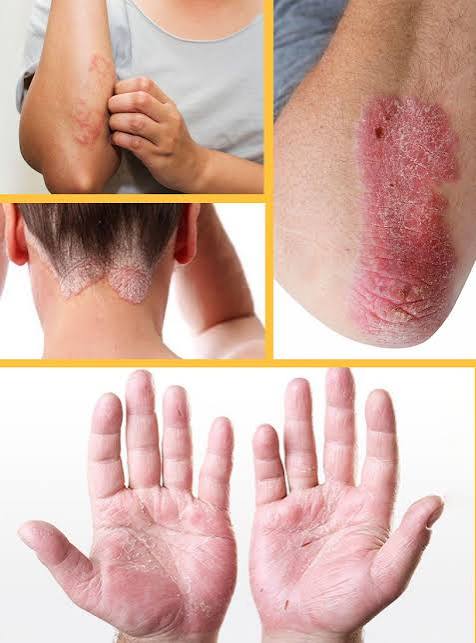 Psoriasis on skin