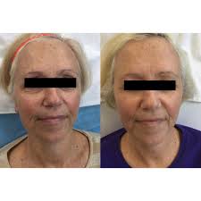 Laser Skin Treatments for Northfield Minnesota — The Lux MedSpa