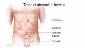 Maybe you would like to learn more about one of these? Dear Mayo Clinic Six Months Ago I Was Diagnosed With A Groin Hernia At The Time My Doctor Said That Abdominal Hernia Abdominal Medical Illustration