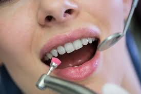 Limpieza dental completa