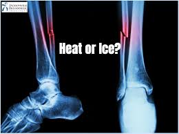 However, while the bones usually take six to eight weeks to knit together, it may take up to a year for the arm to fully return to normal. Is Heat Good For A Broken Bone
