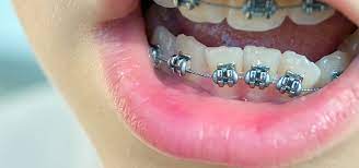 Doch um schiefe zähne oder eine fehlstellung des kiefers zu. Ab Welchem Alter Sollten Zahnfehlstellungen Behandelt Werden 360 Zahnspange