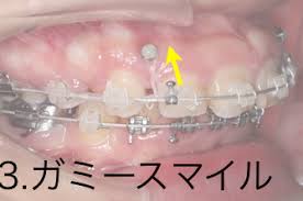 アンカースクリュー矯正 ガミースマイル 前歯の後方移動 千葉県八千代市の矯正歯科専門医 まきの歯列矯正クリニック