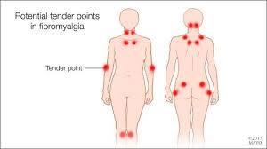 Mayo Clinic Q And A Understanding Myofascial Pain Syndrome
