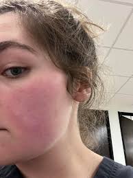 Sooo much to share? Do you suffer from rosacea or red patches