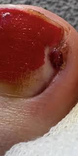 Image result for Akutní zánět nehtového lůžka