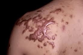 Image result for Keloid