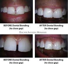 Dental bonding is used to fix large gaps and is preferred to other treatments for its quick result. Dental Bonding In Los Angeles Tooth Bonding Dr Anthony Mobasser