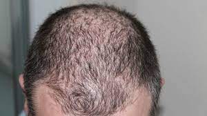 Psikologi rambut gugur dan kesan negatif. 5 Petua Rambut Gugur Yang Boleh Menyelamatkan Penampilan Anda