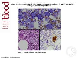 Acquired prca is an uncommon autoimmune disorder that can have multiple causes. Parvovirus B19 Induced Pure Red Cell Aplasia In A Heart Transplant Recipient