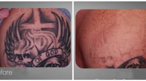 Tattoo removal in cleveland has come a long way, thanks to the groundbreaking technology of the picosure laser. This Ohio Spa Is Offering Free Laser Tattoo Removal For Customers With Racially Influenced Ink Allure