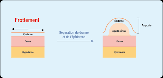 Une ampoule (ampoule de contact) ou cloque (phlyctène) est une ampoule remplie de liquide ou de sang qui survient à la suite d'une pression ou d'un frottement continu inhabituels à un endroit où la peau est épaisse et peu mobile. Reconnaitre Une Ampoule Ou Une Cloque Ameli Fr Assure