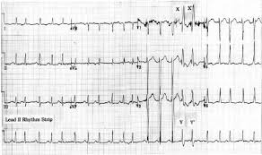 Recommended citation shelly, iris lynn, algorithm for premature ventricular contraction detection from a subcutaneous electrocardiogram signal figure 5. Ecg Review Afib With Pvcs 2004 09 01 Ahc Media Continuing Medical Education Publishing