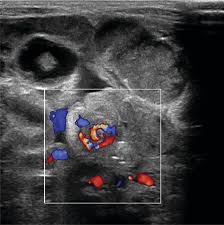 Image result for Midgut Volvulus