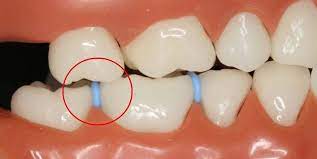 21 Things Everyone Who Wore Braces Will Definitely Remember Getting Braces Spacers For Braces Teeth Braces