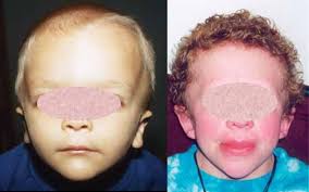 Potocki Lupski Syndrome Medlineplus Genetics