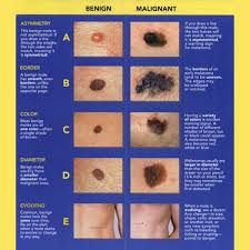 its mole check time mole sun care health beauty