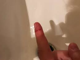 Bei einem abszess auf der haut oder anderswo gilt: Was Tun Bei Schnittwunde Finger Gesundheit Medizin Verletzung