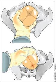 Image result for Manual Rotation in Occipitoposterior Presentation