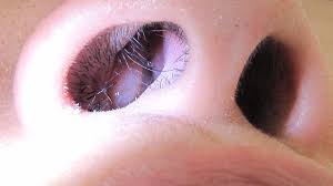 Nasal Polyps Causes Symptoms And Diagnosis Nose Hair Removal Blocked Nose Staph Infection