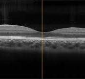 Optische Kohärenztomographie (OCT)