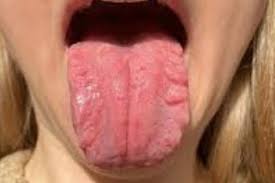 Image result for Fissured tongue