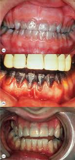 Tooth Color An Overview Sciencedirect Topics